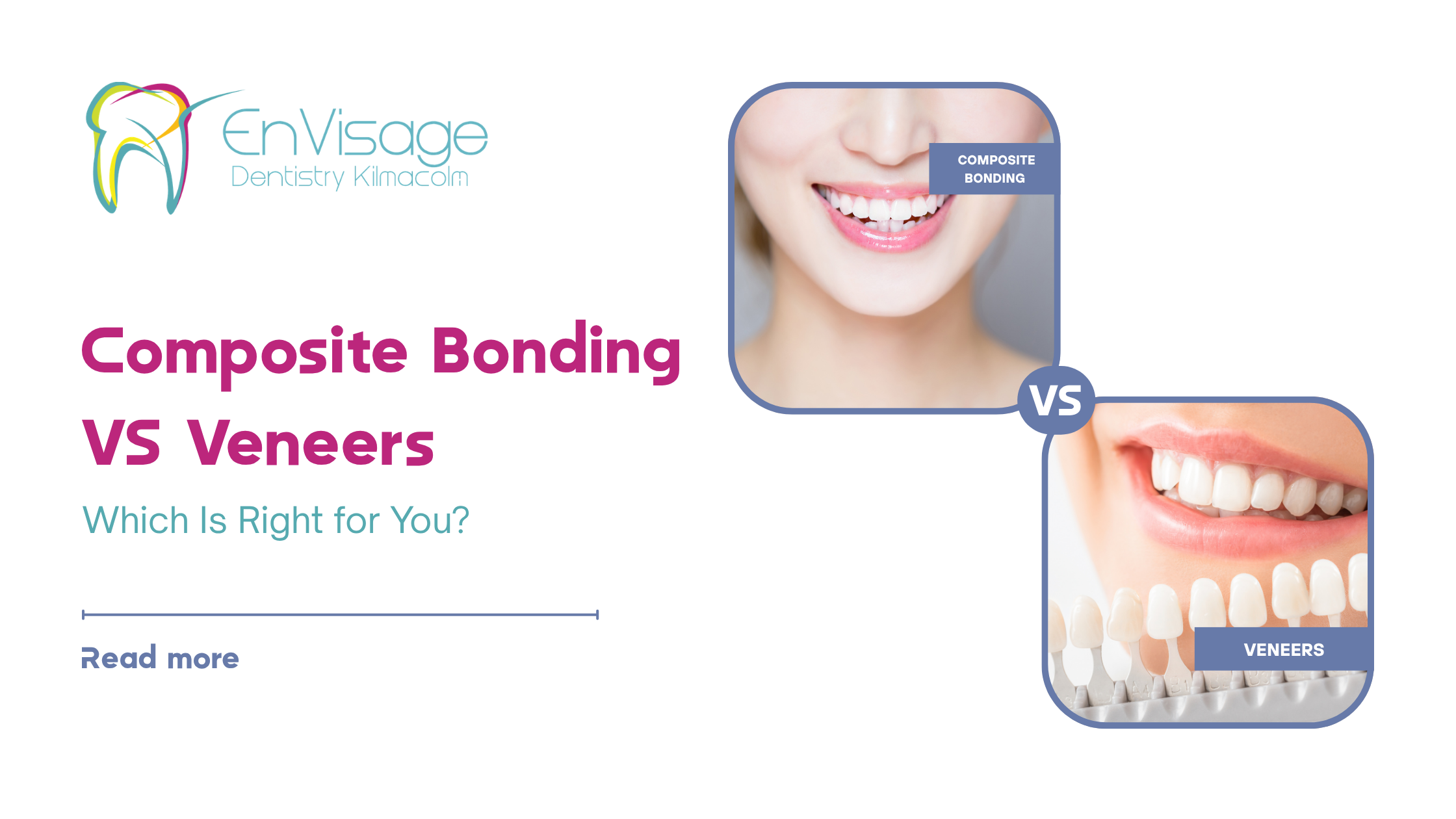 Composite Bonding vs Porcelain Veneers